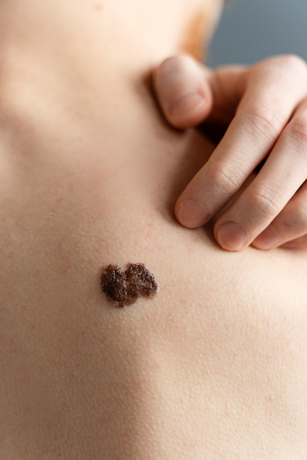 Birthmark Removal - Sahiwal Aesthetic